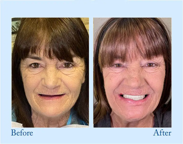 Premium Dentures - Image 6