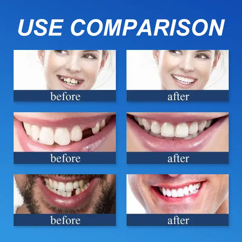 (Affordable --Advanced Customized Full Denture Set🦷 - Image 10