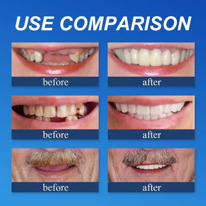 (Affordable --Advanced Customized Full Denture Set🦷 - Image 11