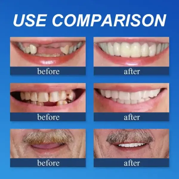 Affordable –Advanced Customized Full Denture Set🦷 - Image 3