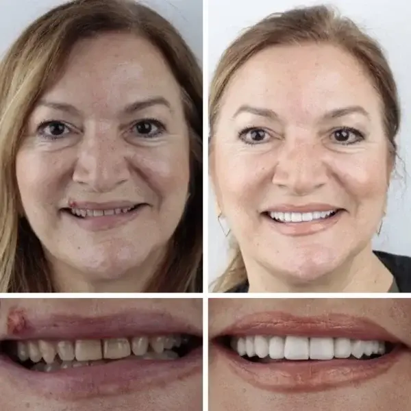 Affordable –Advanced Customized Full Denture Set🦷 - Image 10