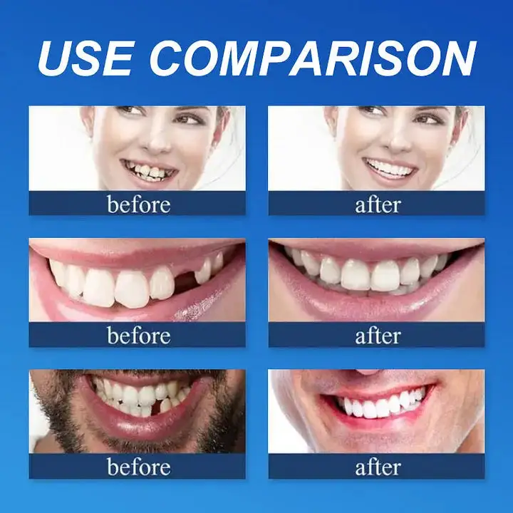 Advanced Customized Full Denture Set🦷 - Image 12