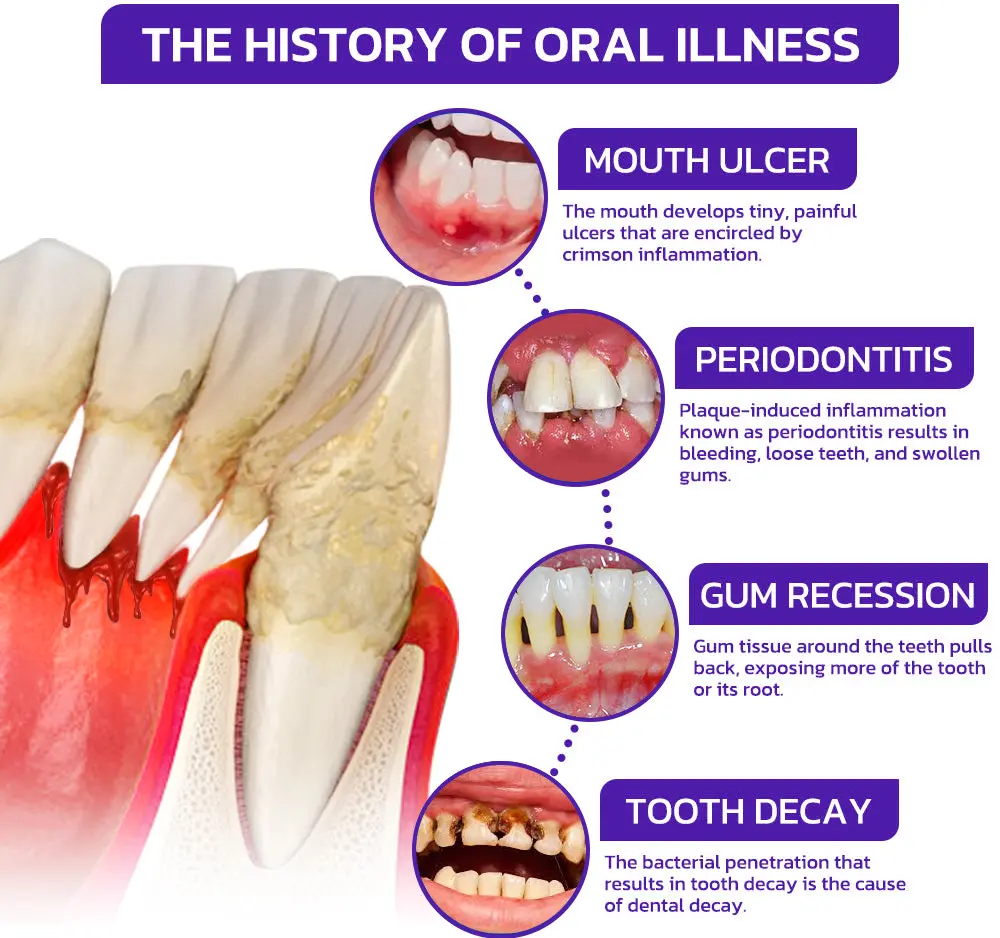 Bee Venom Dental Therapy Oral Power - Image 7
