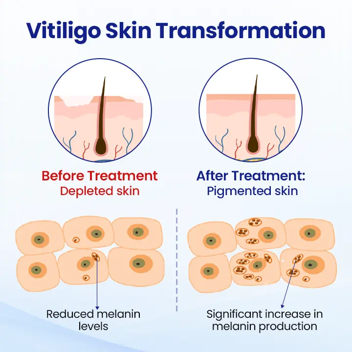 Vitiligo Treatment Spray - Image 6