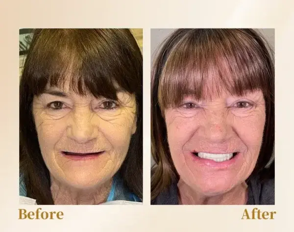 –🦷Advanced Customized Full Denture Set🦷 (⏰Limited time discount last 30 minutes⏰)💎💎 - Image 10