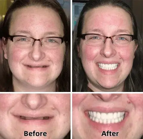 Advanced Custom-Fit Functional Dentures - Image 4