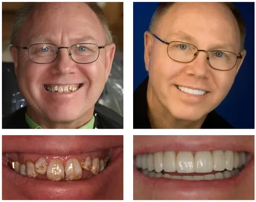 🦷 Custom-Fit Functional Dentures 😁 Smile with Confidence - Image 6