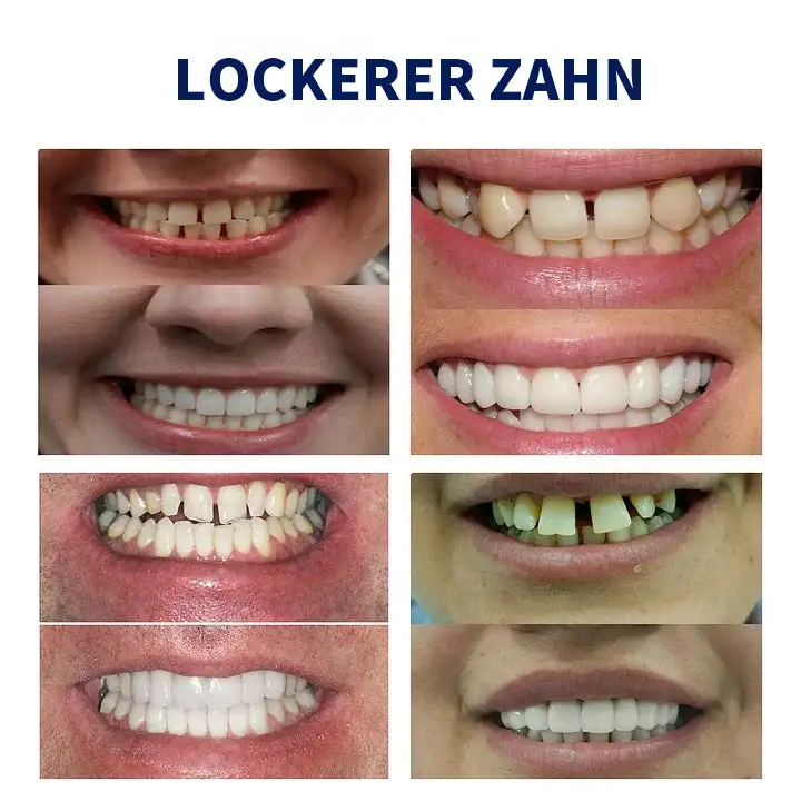 🦷 Fortgeschrittenes, maßgeschneidertes Vollprothesen-Set 🦷 (⏰ Limitierter Rabatt, nur noch 30 Minuten verfügbar ⏰) - Image 8