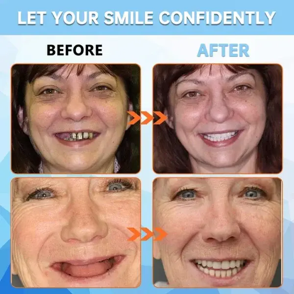 Adsorptive Dentures - Image 5