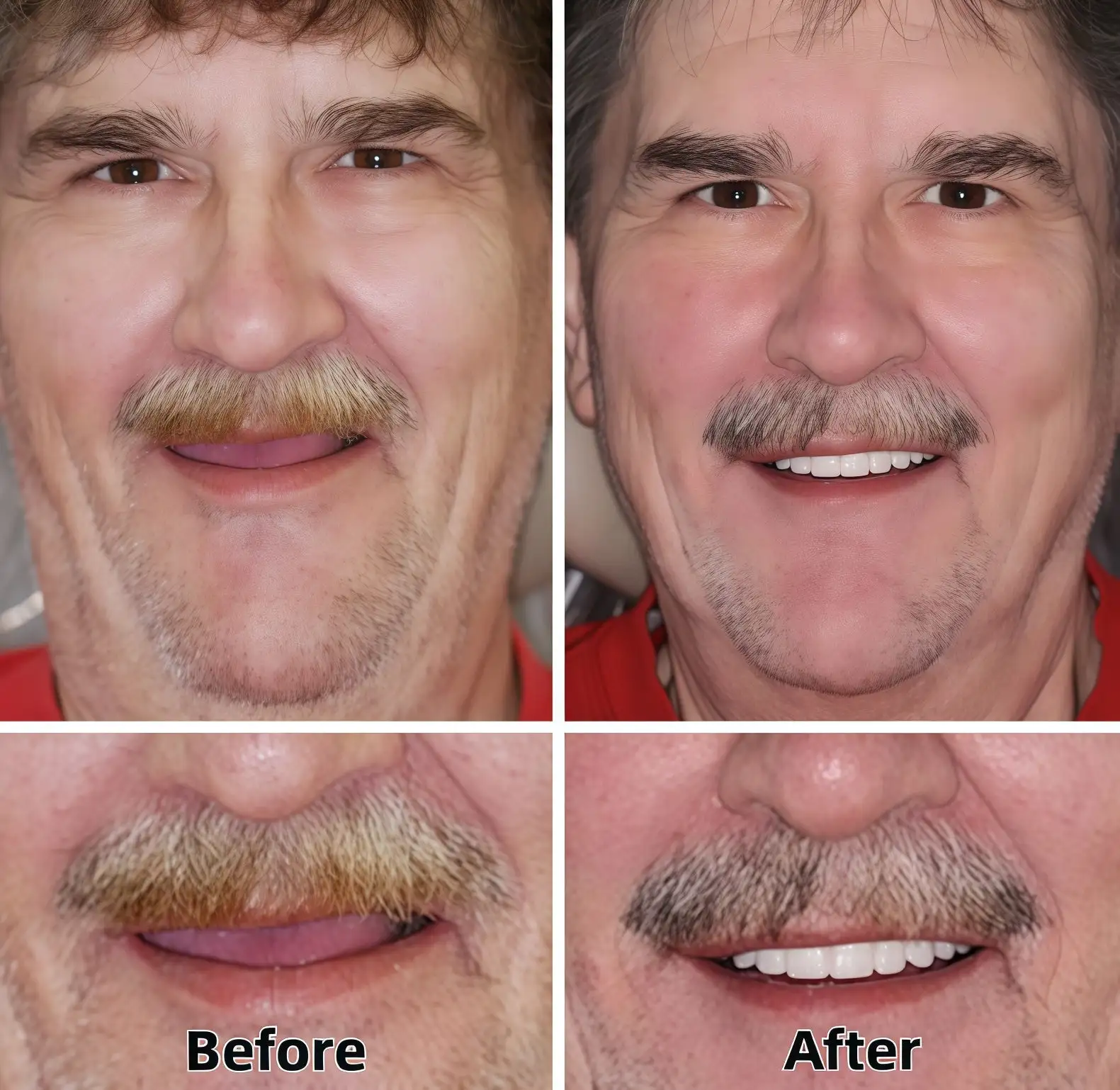 Advanced Custom-Fit Functional Dentures - Image 4