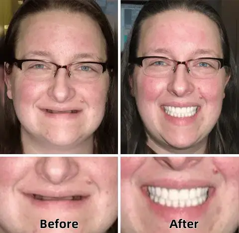 Advanced Custom-Fit Functional Dentures - Image 2