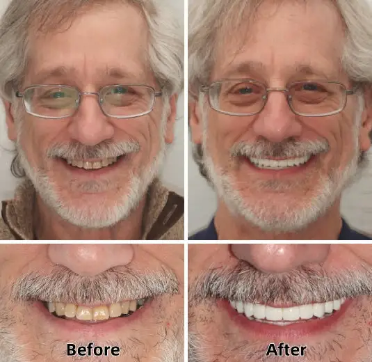 Advanced Custom-Fit Functional Dentures - Image 3
