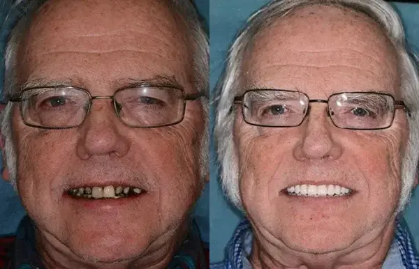 š¦·Advanced Customized Full Denture Set𦷠(ā°Limited time discount last 30 minutesā°) - Image 8