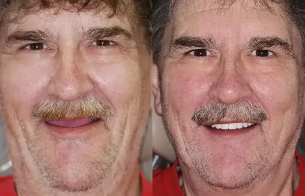 š¦·Advanced Customized Full Denture Set𦷠(ā°Limited time discount last 30 minutesā°) - Image 9
