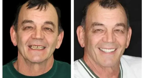 Premium Dentures - Image 4