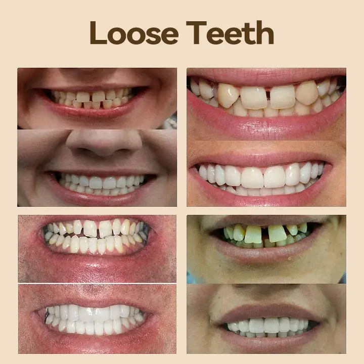 ๐ฑโ๐๐ฆ- ๐๐ซ๐๐ฆ๐ข๐ฎ๐ฆ ๐๐๐ง๐ญ๐ฎ๐ซ๐- (โจSuitable for all mouth shapes, custom-made dentures for a perfect fitโจ๏ผ - Image 6