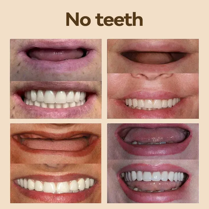 ๐ฑโ๐๐ฆ- ๐๐ซ๐๐ฆ๐ข๐ฎ๐ฆ ๐๐๐ง๐ญ๐ฎ๐ซ๐- (โจSuitable for all mouth shapes, custom-made dentures for a perfect fitโจ๏ผ - Image 7