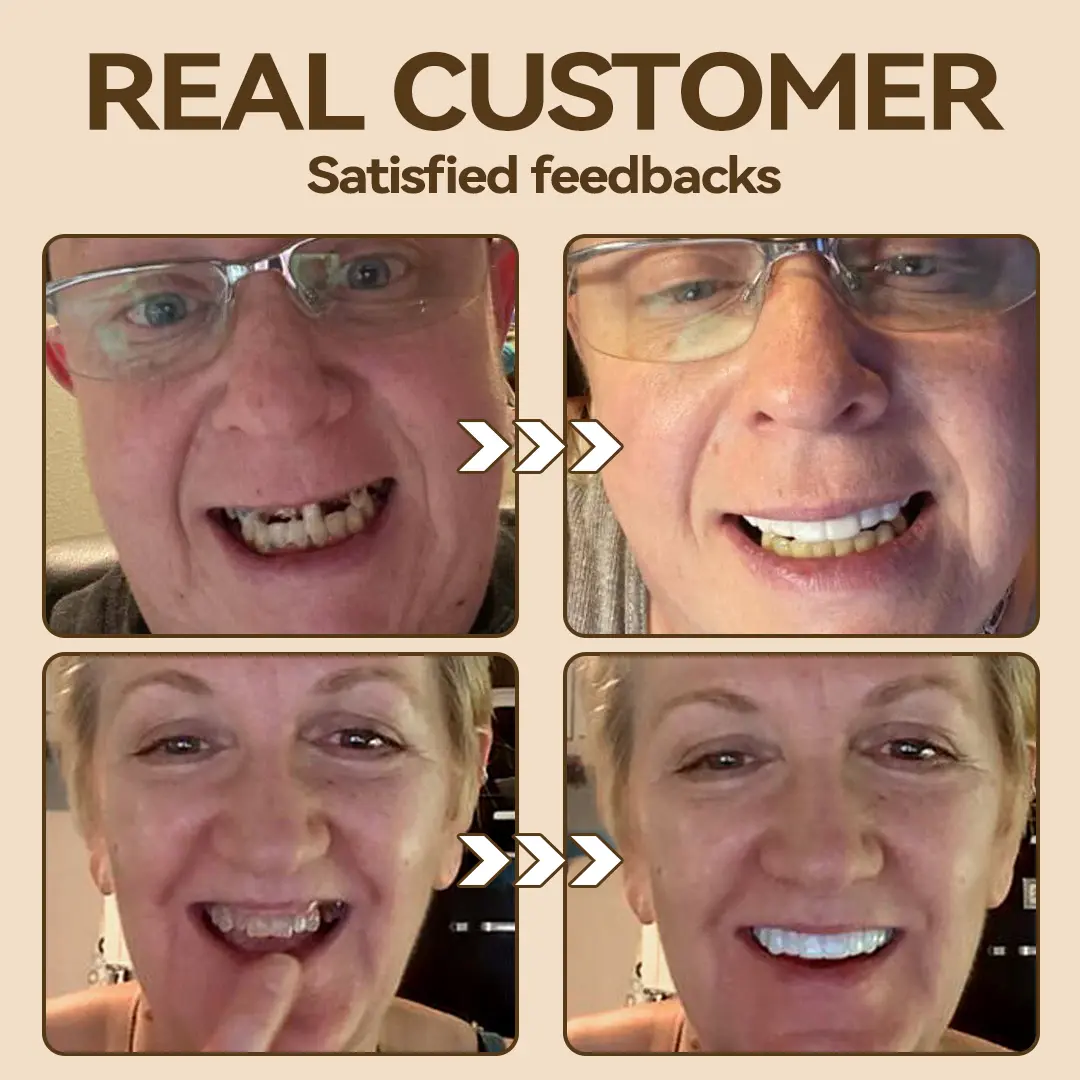 ๐ฑโ๐๐ฆ- ๐๐ซ๐๐ฆ๐ข๐ฎ๐ฆ ๐๐๐ง๐ญ๐ฎ๐ซ๐- (โจSuitable for all mouth shapes, custom-made dentures for a perfect fitโจ๏ผ - Image 8