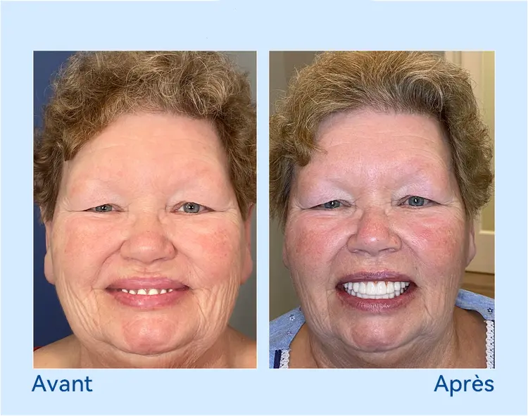 🚀𝐏𝐫𝐨𝐭𝐡è𝐬𝐞 𝐃𝐞𝐧𝐭𝐚𝐢𝐫𝐞 𝐏𝐫𝐞𝐦𝐢𝐮𝐦 (⏰Remise à durée limitée : 30 dernières minutes⏰) - Image 11