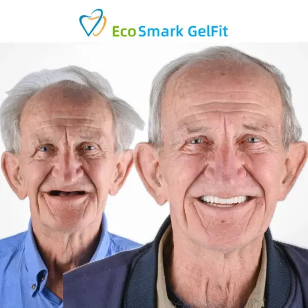 GelFit Dentures - Image 3