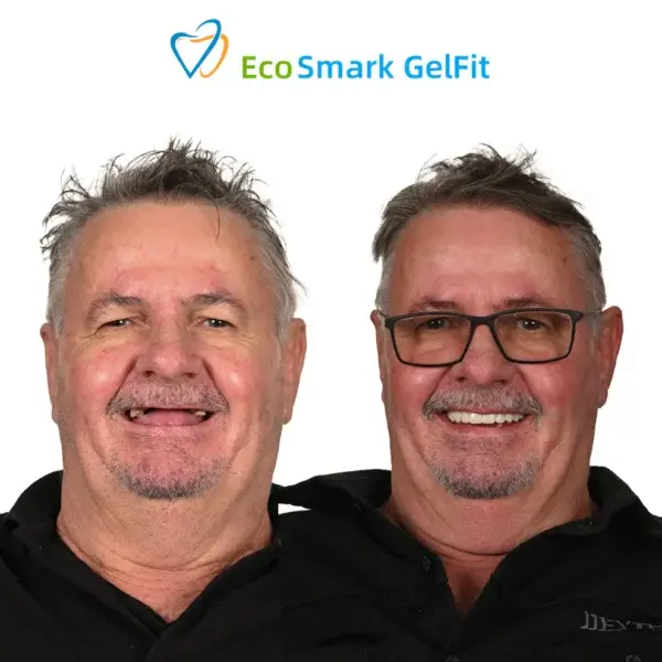 GelFit Dentures - Image 5