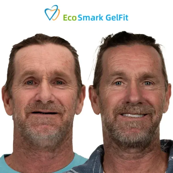 GelFit Dentures - Image 7