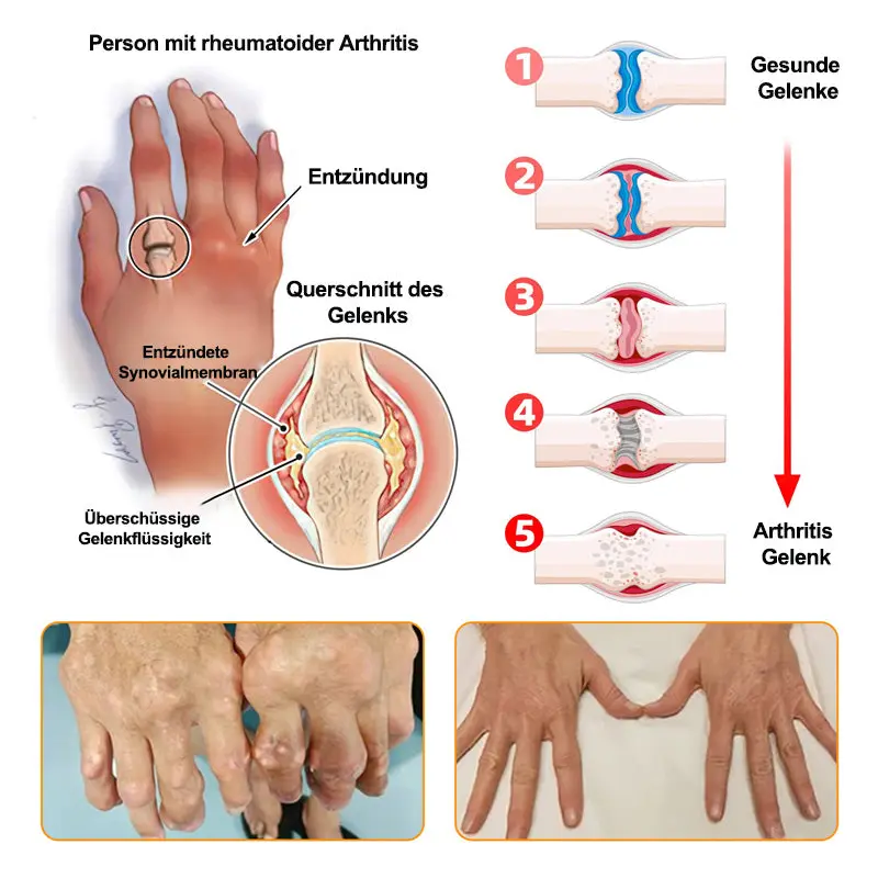 🐝 Offizieller Bee Venom & Lithospermum Comfort Cream Wenn Gehen, Stehen oder Schlafen unangenehm wird — tägliche Schmerzlinderung & Knochenkomfort für ältere Erwachsene - Image 10