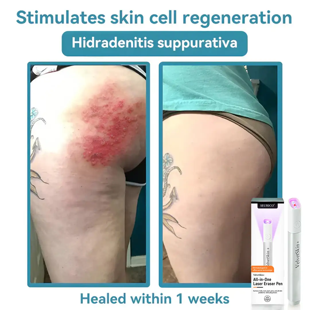 VelvetSkin+ All-in-One Laser Eraser Pen - Image 10