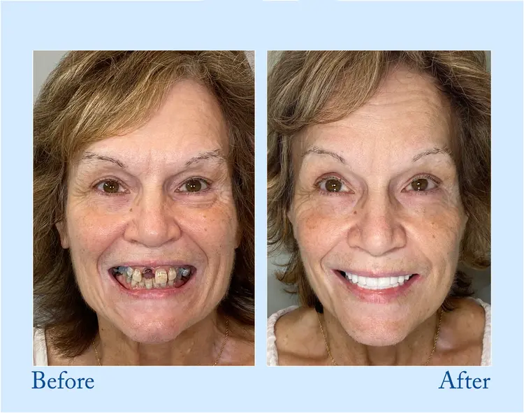 Custom-Fit Functional Dentures — Perfectly Fitted in Minutes at Home - Image 10