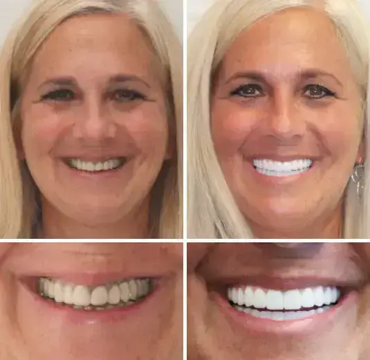 Advanced Customized Full Denture Set - Image 5