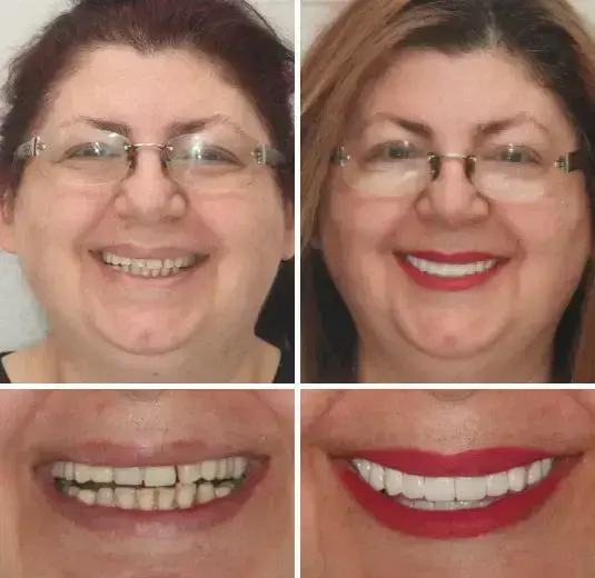 Advanced Customized Full Denture Set - Image 7