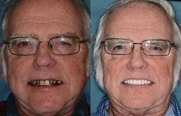 Advanced Customized Full Denture Set - Image 8