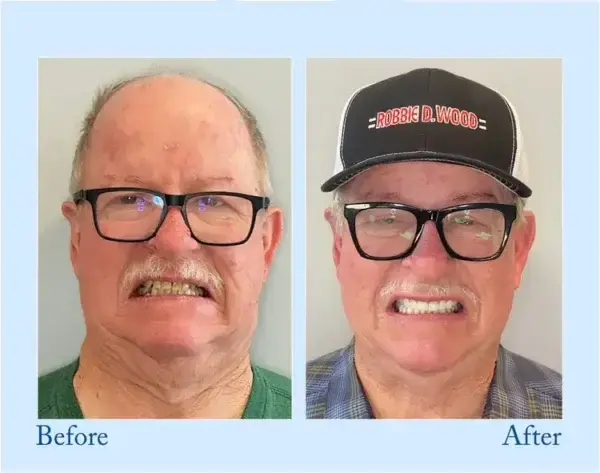 Custom-Fit Functional Dentures – Perfectly Fitted in Minutes at Home - Image 6
