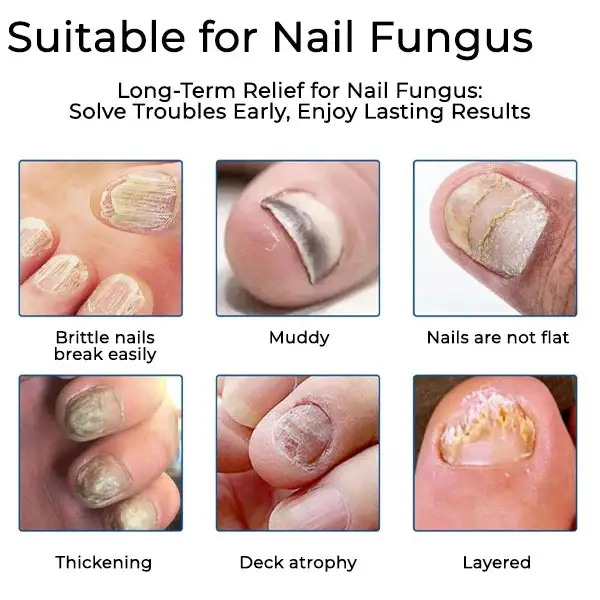 FUNGAL NAIL PATCHES - Image 2